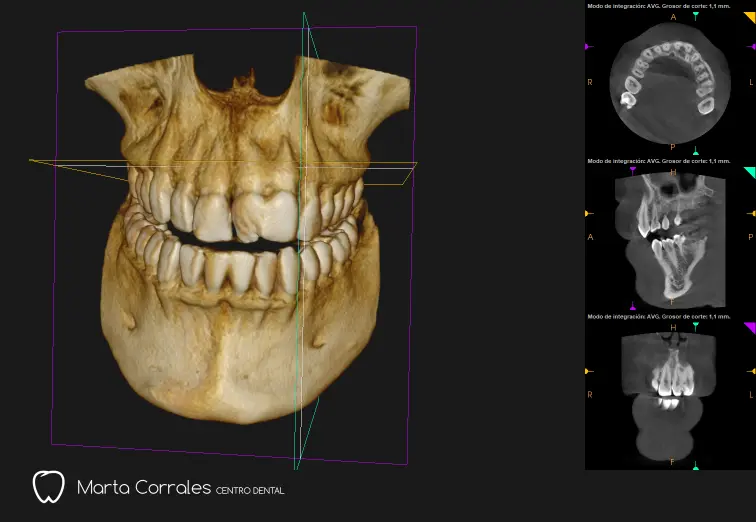 implante dental en Ronda - Clínica Dental Marta Corrales