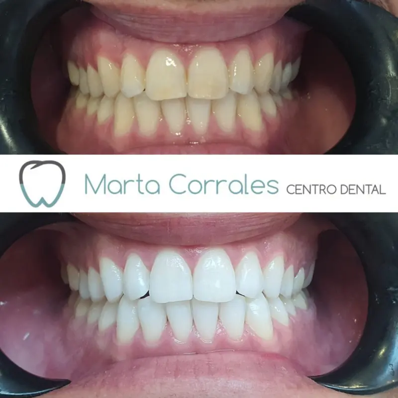 paciente trabajo finalizado blanqueamiento dental en Ronda - Clínica dental Marta Corrales